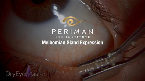 Meibomian Gland Expression - YouTube