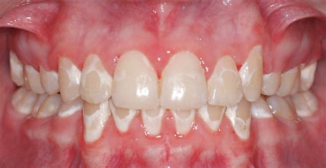 Why do I have white spots on my teeth? - Peninsula Orthodontics