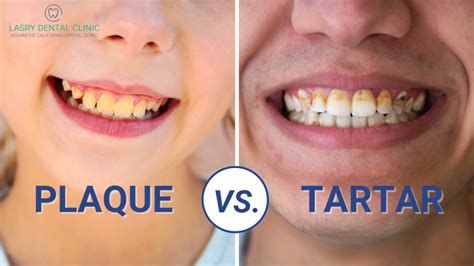 Plaque vs. Tartar and How To Remove Them At Home