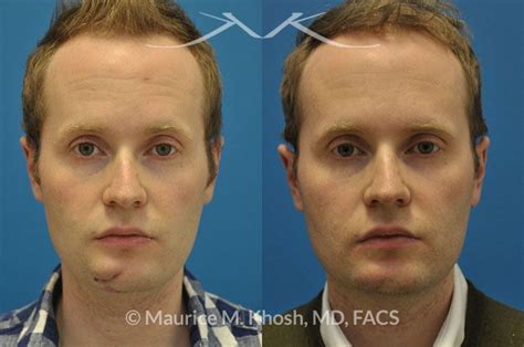 New York Scar Revision, Removal | Maurice M. Khosh MD, FACS