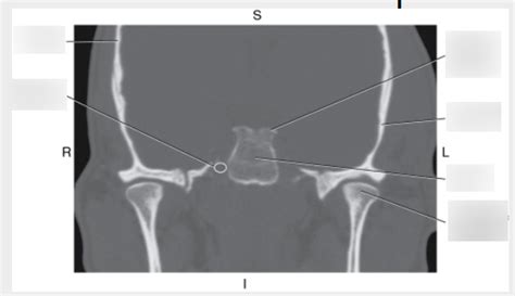 Coronal CT of Dorsum Sella Diagram | Quizlet