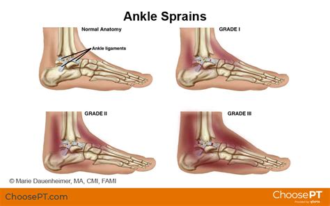 Sprained Ankle Treatment, Rehabilitation Exercises | atelier-yuwa.ciao.jp