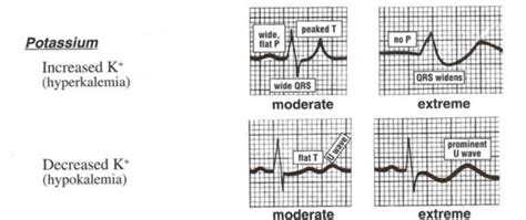 Hypokalemia ECG Changes [With Examples] - Manual of Medicine