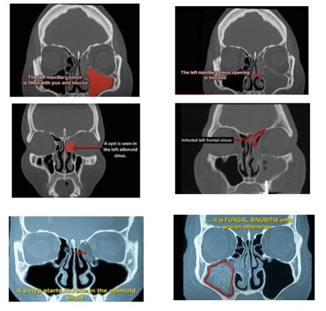 Chronic Sinusitis Surgery in Singapore | Sinus Operation