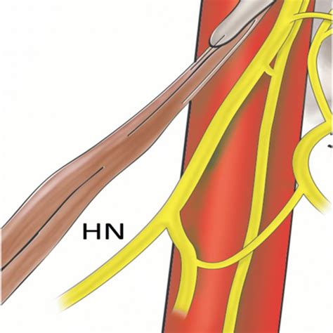 Nerves of the right jugular foramen and their relationships | Download ...