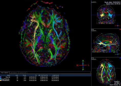 Scientists Surprised To Find Neurons in Visual Cortex of the Brain ...