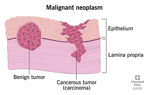 Which Word Describes a Tumor That Is Cancerous