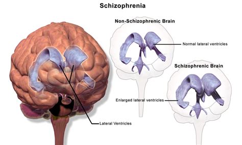 Difference Between Schizophrenia and Schizoaffective Disorder | Signs ...