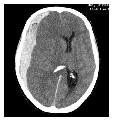 Subdural Hemorrhage CT Scan