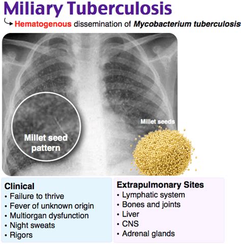 Disseminated Tuberculosis Causes Symptoms Treatment