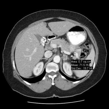 Adrenal Adenoma Imaging: Practice Essentials, Computed Tomography ...