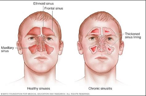 Acute Frontal Sinusitis - MBBCH Health Encyclopedia