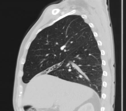 Right middle lobe syndrome | Radiology Reference Article | Radiopaedia.org