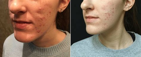 Acne Scars Injections New Jersey - Reflections Center