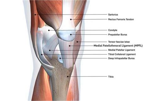 MEDIAL PATELLOFEMORAL LIGAMENT (MPFL) RECONSTRUCTION SURGERY - Midwest ...