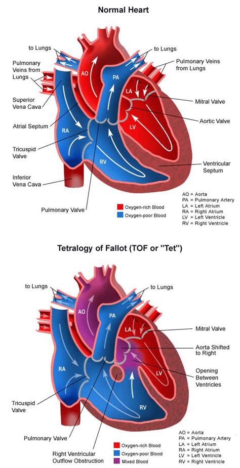 Tetralogy of Fallot | Congenital Heart Defects - Children's Hospital of ...