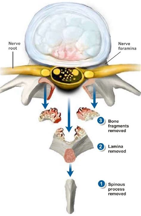 Lumbar Decompression/Laminectomy – Endospine360