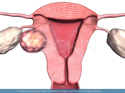 Fibroids: Types, Causes, and Symptoms - Seckin Endometriosis Center