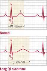 Prolonged QTc on One EKG but Not the Others? » Scary Symptoms