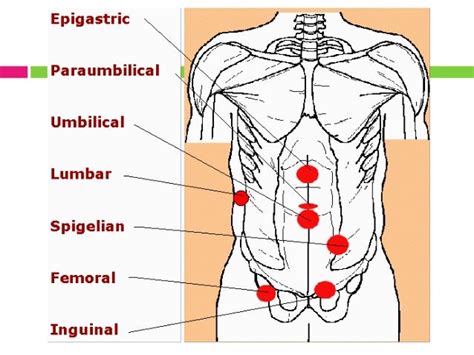 Hernia