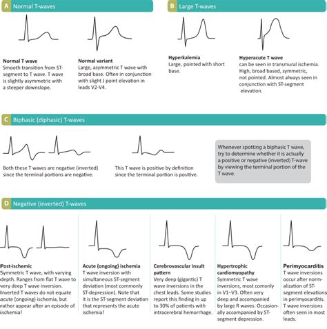 ECG interpretation: Characteristics of the normal ECG (P-wave, QRS ...