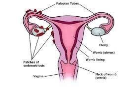 Discover All Endometriosis Symptoms - Marninixon.com