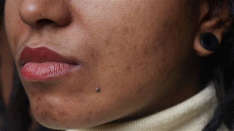 How to Treat Acne and Post-Acne Marks on Dark Skin, According to a ...