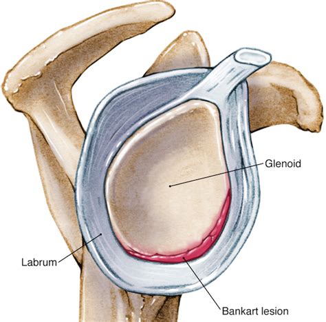 Bankart - Hill-Sachs lesions