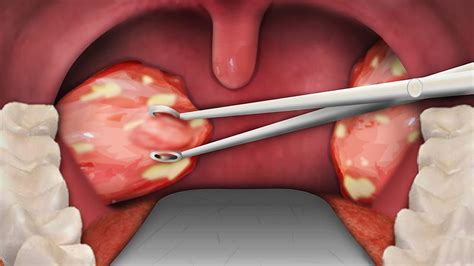 Tonsillectomy - Indications, Recovery Time, Cost, and Complications