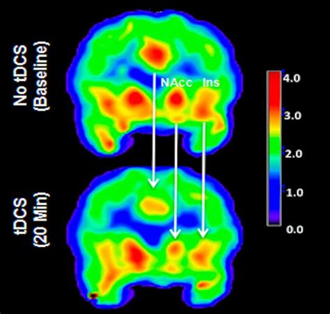 Brain releases powerful, opiate-like painkiller in repsonse to electric ...