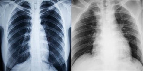 SEE: This is what your lungs look like when you smoke | Health24