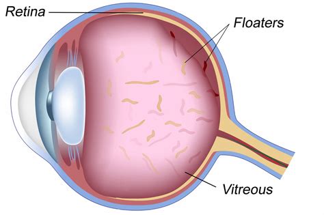 Eye Floaters Cause | Symptoms and Treatments - The Kitchensurvival