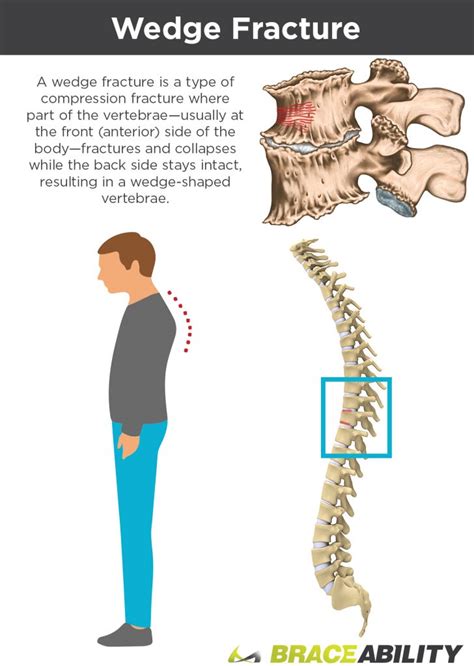 [DIAGRAM] Diagram Of Vertebral Fracture - MYDIAGRAM.ONLINE