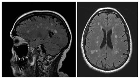 Multicenter Study: Multiple Sclerosis Misdiagnosis Supports Improved ...