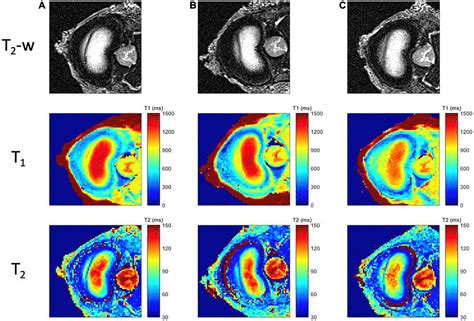 Nucleus Pulposus Mri