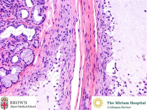 mucous cyst lower lip - pictures, photos