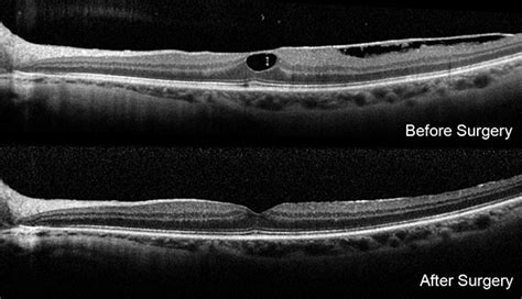 Macular Pucker Surgery When Can You Read Again - Perez Senter