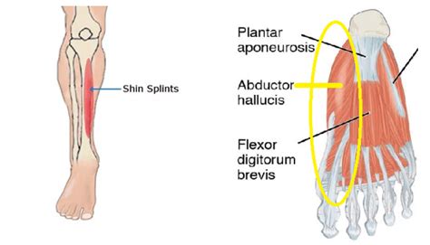 Shin splints: think foot function! - Capital Clinic Physiotherapy