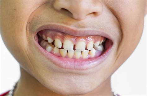 Do Gaps in the Teeth Always Mean Braces? | Kaplan Orthodontics