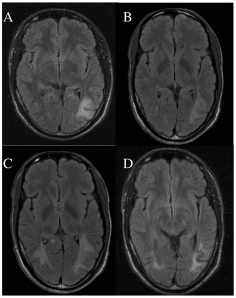 MRI on admission and follow-up. A. MRI (flair T2) performed on ...