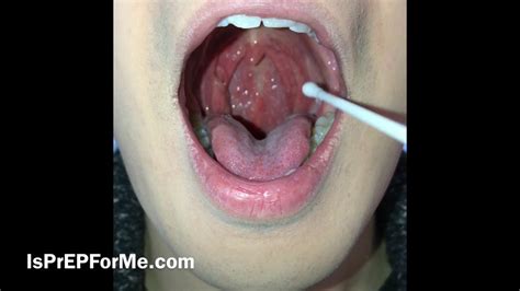 Throat Swab Pharyngitis Tonsillitis | The Best Porn Website