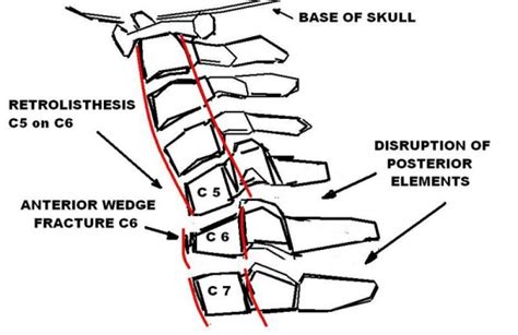 Anterior cervical wedge fracture - WikEM