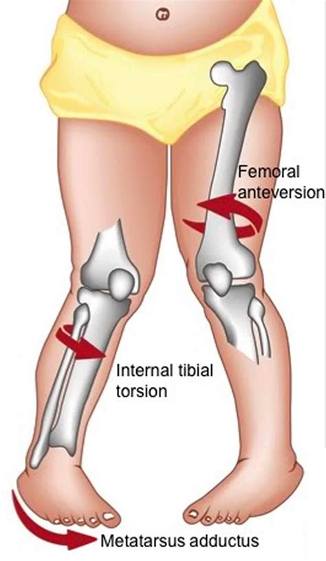 Femoral anteversion causes, symptoms, diagnosis, treatment & prognosis