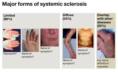 Scleroderma | Institute of Immunity and Transplantation - UCL ...