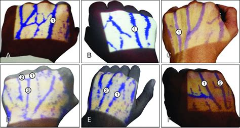 (A) Left hand showing prominent dorsal metacarpal vein (1) in the ...