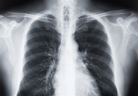 Chest X Ray Vs Ct Scan Of The Lungs