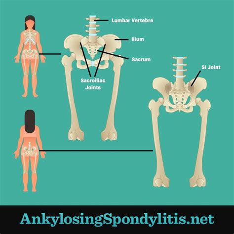 Axial spondyloarthritis symptoms – Artofit