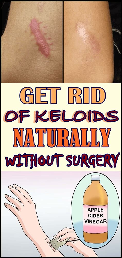 Keloid Treatment