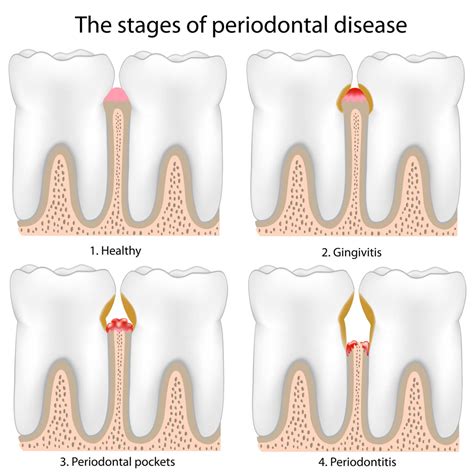 Tooth pain - Southlake Endodontics