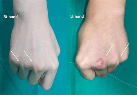 Frontiers | Treatment of bilateral congenital extensor tendon ...